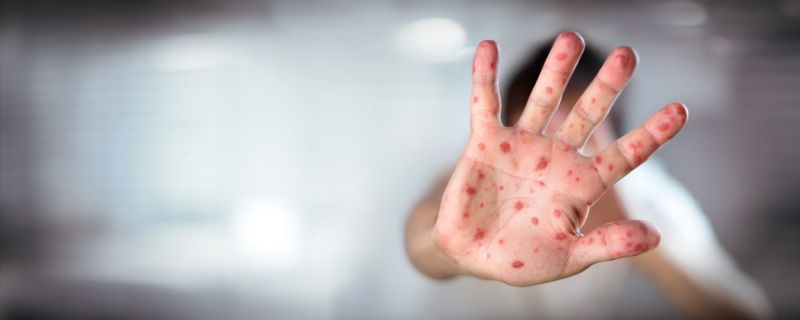 Measles Outbreak Expands: What You Need to Know